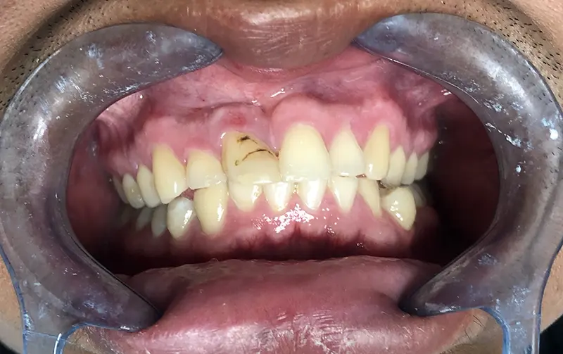 Composite Restorations & Cavity Treatment 3