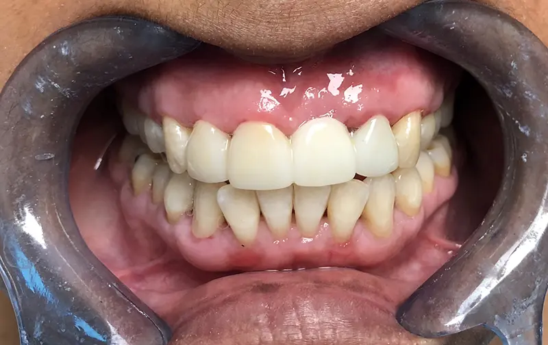 Dental Bridge Cases 9