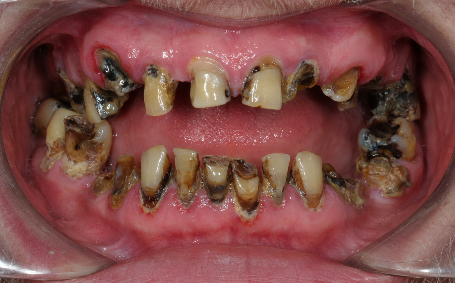 Damaged teeth before full mouth rehabilitation