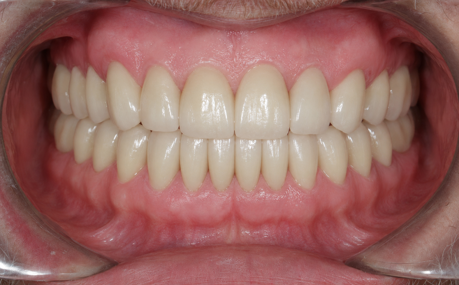 Restored teeth after full mouth rehabilitation